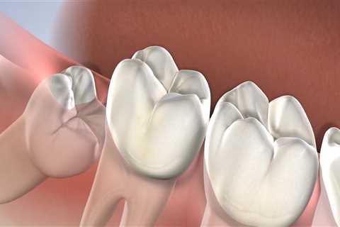 What Happens During Wisdom Teeth Removal? A Comprehensive Guide