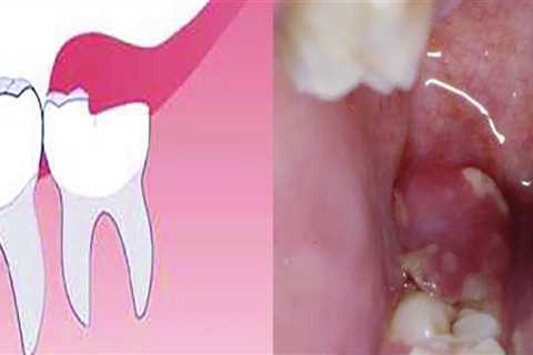 What Are the Signs of Complications After Wisdom Teeth Removal?