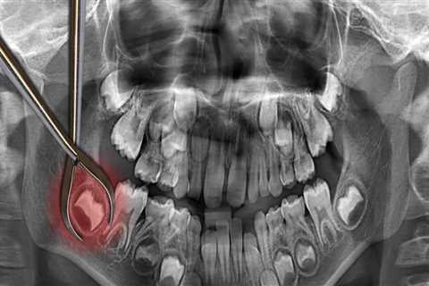 How Long Does It Take for the Pain to Go Away After Wisdom Teeth Removal?