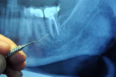 Root Canal vs Tooth Extraction: What's the Difference?