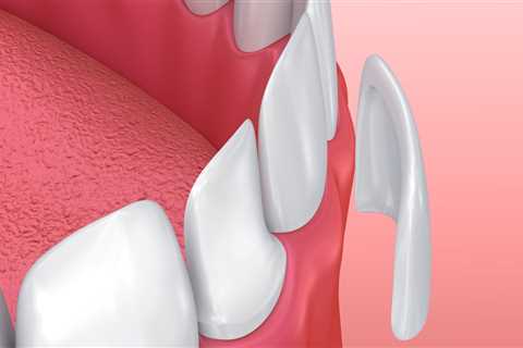 Laser Versatility In Georgetown Cosmetic Dentistry And Its Application In Porcelain Veneers