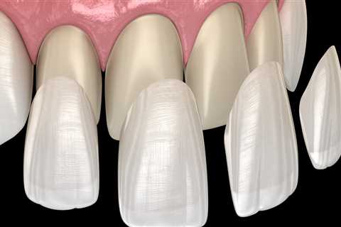 Why Dental Veneers In Waco Are Worth The Investment