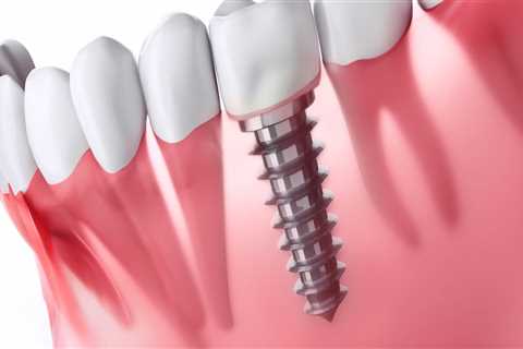 Can dental implants cause health issues?