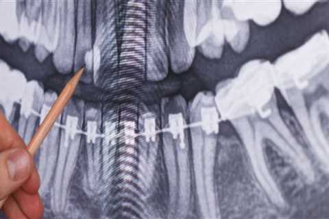 What are the different types of dental x-rays?