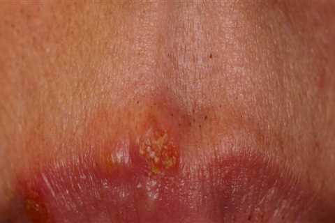 Oral Herpes Treatment: An Overview of Oral Medications