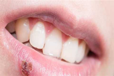 Understanding Recurring Outbreaks of Oral Herpes