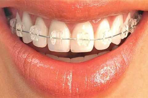 Are Clear Aligners Visible? An Expert's Perspective