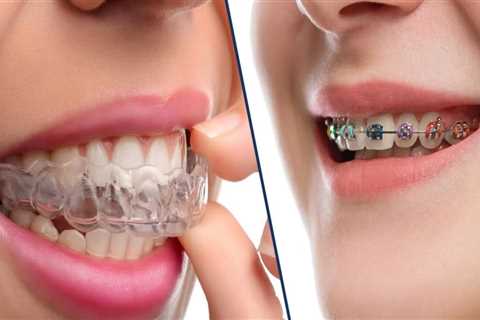 Comparing Clear Aligners and Invisalign: What's the Difference?