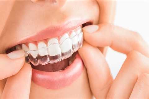 Do Clear Aligners Work Faster Than Braces?