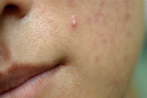 Antibiotics for Acne: Exploring Treatment Options