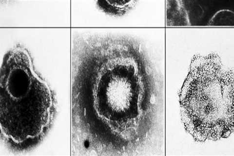 Testing for Herpes Simplex Virus Type 1 and Type 2