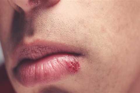 Essential Oils for In Mouth Herpes: An Overview