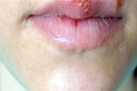 Herpes Simplex Virus Type 2: Causes, Symptoms, and Treatment