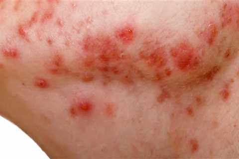 Menstrual Cycle and Acne: Causes, Symptoms, and Treatment