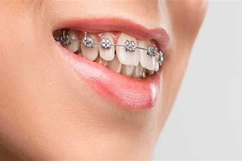 Can Braces be Permanent?
