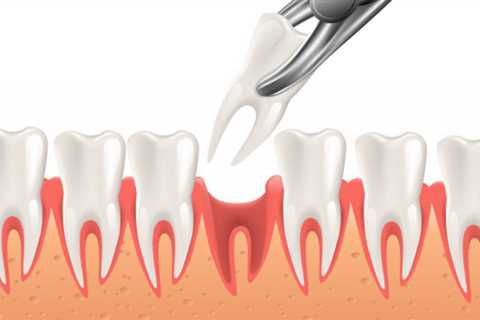 Facts About Tooth Extractions Uncovered