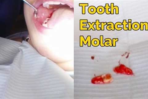 Tooth Extractions for Beginners