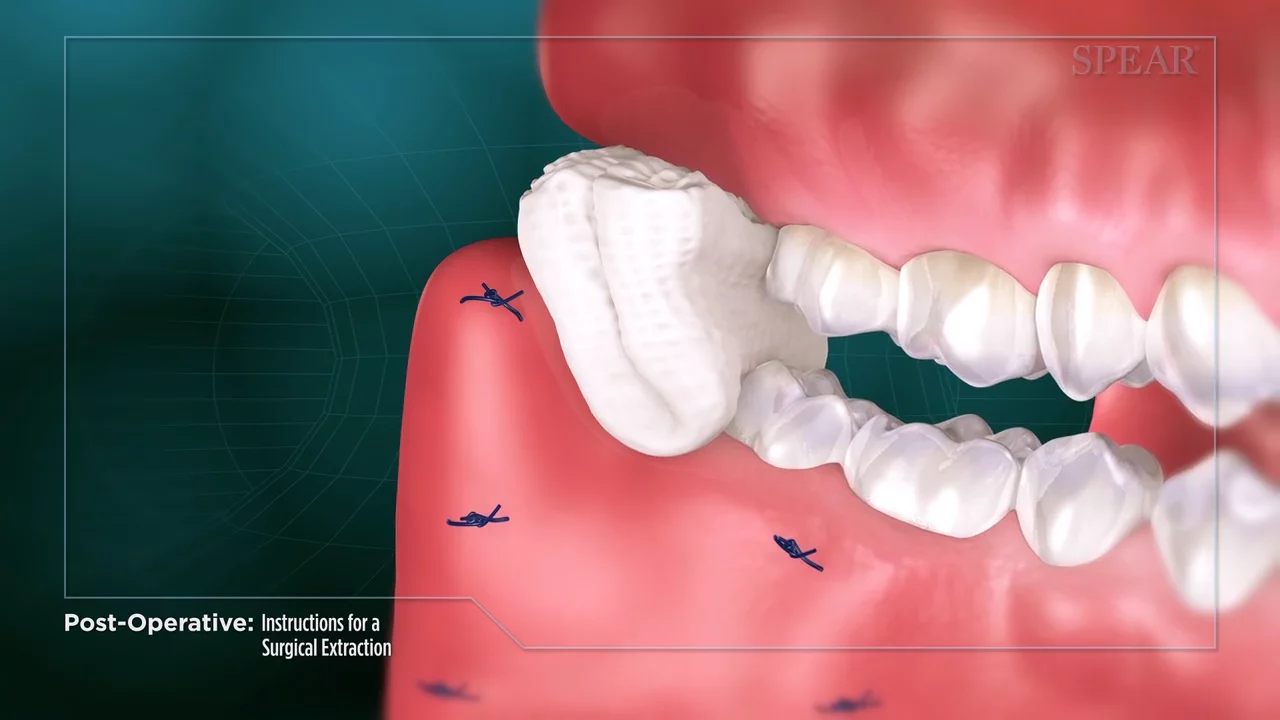 Some Known Factual Statements About Tooth Extractions