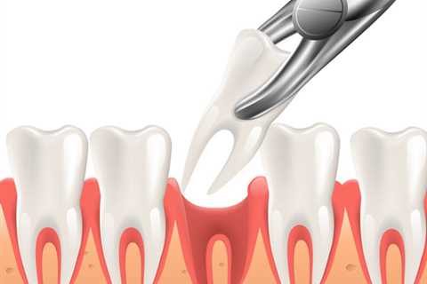 How Tooth Extractions can Save You Time, Stress, and Money.