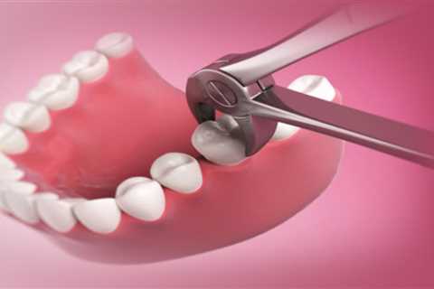 What Does Tooth Extractions Do?