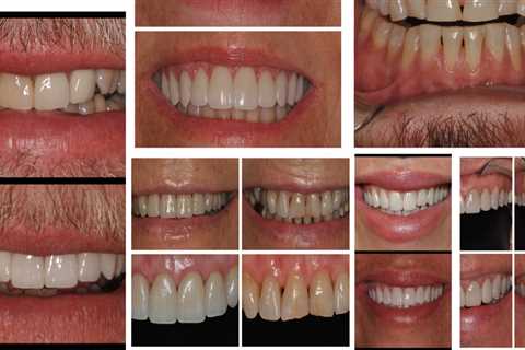 Are Dental Veneers the Right Solution for Your Smile Makeover?