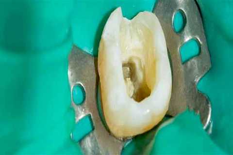 Are root canals a safe and effective treatment option for dental infections?
