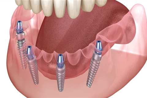 The Complete Guide To All-On-Four Dentures In London: Everything You Should Know