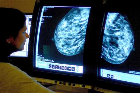 Scientists develop ‘life-saving’ AI that predicts if breast cancer will spread