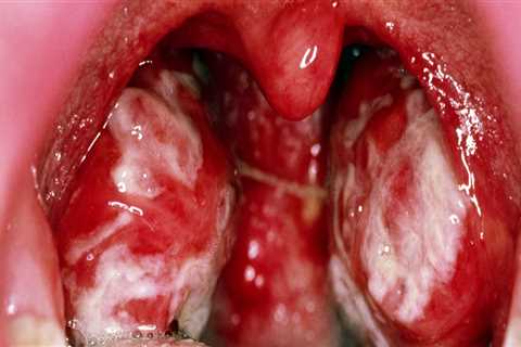 Transmission of Epstein-Barr Virus (EBV)