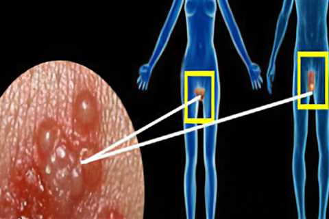 Understanding HSV-2 Infection