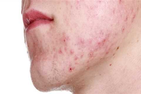 Acne: A Comprehensive Overview