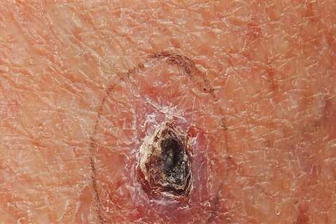 Basal Cell Carcinoma: Everything You Need to Know