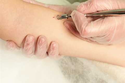 Radiofrequency Ablation: Non-Surgical Mole Removal