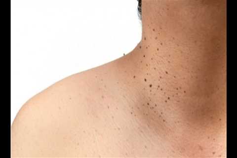 Applying Over-the-Counter Creams to Skin Tags