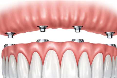 Dentures vs. Dental Implants: Which Is the Better Choice