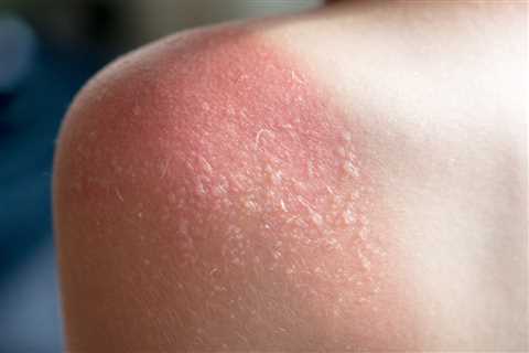 The Impact of Sun Exposure on Skin Health