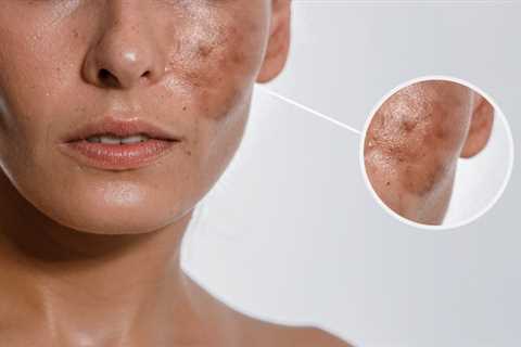 Facial Treatment Methods for Various Skin Issues