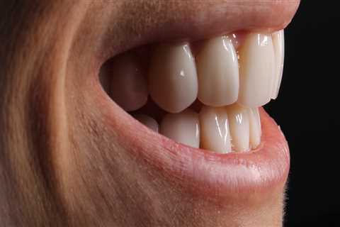 Transform Your Smile With Porcelain Veneers After Wisdom Teeth Removal In Austin