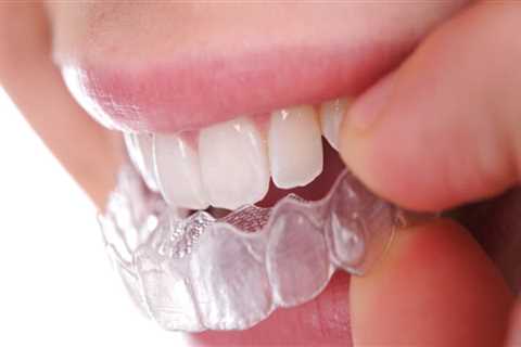 Invisible Orthodontics: Achieving A Perfect Smile With Invisalign Clear Braces In Austin