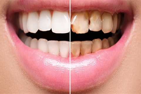 How long are veneers supposed to last?