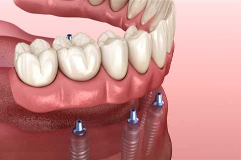 Revitalize Your Smile: All-On-Four Dentures And Cosmetic Dentistry In Cedar, TX
