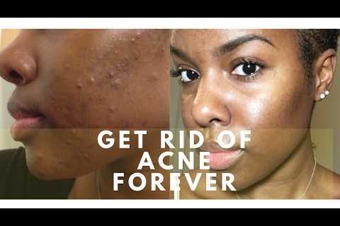 Get Rid of Acne With Vitamins!! | Natural Acne Remedy | NO Diet Change