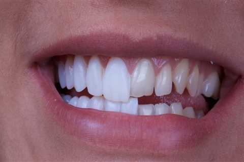 All You Need To Know Before Getting Porcelain Veneers In Round Rock, Texas