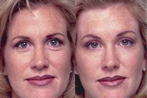 How To Lift Eyebrows With Botox