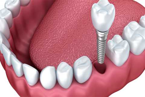 The Cost of Teeth Implants: An Investment Worth Making