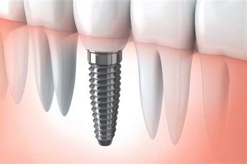 Do Dental Implants Require Regular Check-Ups After Placement?