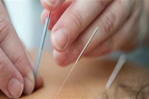 Unraveling the Mystery of Acupuncture: How Does it Work Step by Step?
