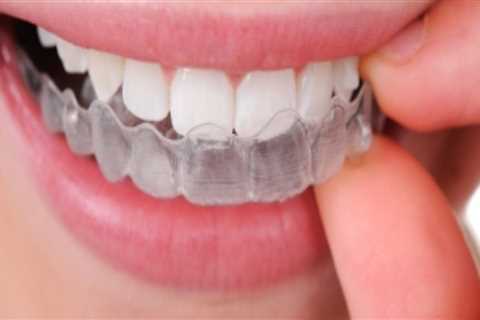 Straighten Your Teeth Discreetly With Invisalign Clear Braces In Commerce City