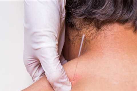 What is Dry Needling and How Does it Differ from Acupuncture?