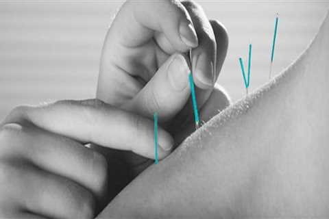 The Difference Between Traditional Chinese Acupuncture and Western Medical Acupuncture